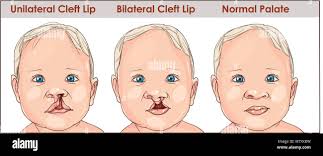 Cleft palate immagini e fotografie stock ad alta risoluzione