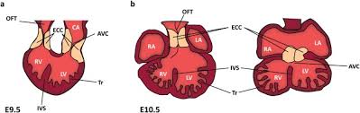 Image result for Endocardial Cushion Defect