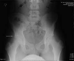 Hip pain in children is always a potentially serious and needs urgent assessment. Injuries Of The Pelvis And Lower Extremities Trauma Strange And Schafermeyer S Pediatric Emergency Medicine Fourth Edition Strange Pediatric Emergency Medicine 4th Ed