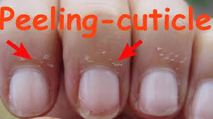 Dry skin around nails cuticles. How To Care For Skin Peeling Near Nails D I Y 4 30days30diy Youtube
