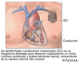 Desfibrilador — aparato que permite practicar la desfibrilación. Desfibrilador Cardioversor Implantable Medlineplus Enciclopedia Medica