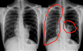 The air pushes on part or all of the lung, causing it to collapse. When My Left Lung Collapsed Joe Antognini