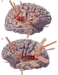 Image result for Cerebral Subcortex