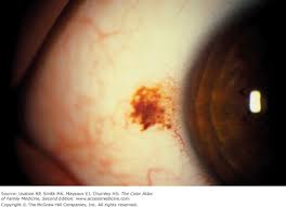 Image result for lesion sclera