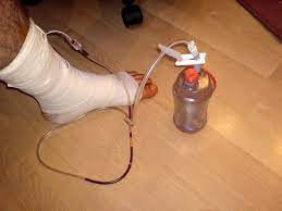Drainage Medizin Wikipedia