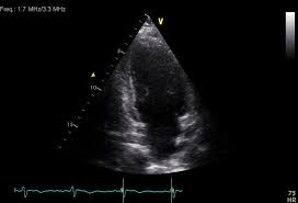 .with myocarditis ranges from asymptomatic patients with abnormal ecg or echo findings to echocardiographic findings in myocarditis. Acute Myocarditis With Normal Wall Motion Detected With 2d Speckle Tracking Echocardiography In Echo Research And Practice Volume 3 Issue 1 2016