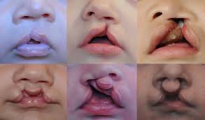 Image result for Cleft Lip