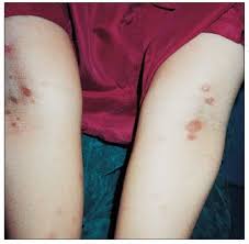 Image result for Secondary Syphilis