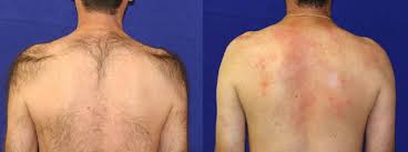 Shaving is a one option when removing hair in a hurry. Laser Hair Removal Patel Plastic Surgery Bck Patel Md