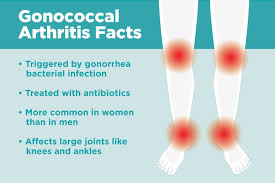 Image result for gonorrhea symptoms