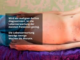 Maybe you would like to learn more about one of these? Lebenserwartung Bei Aszites Wie Ist Die Prognose