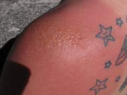 Sunburn On Tattoos Treatment Prevention Authoritytattoo