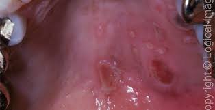 Image result for oral herpes symptoms roof of the mouth