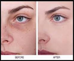 Genuine Black And White Bleaching Cream Before And After Pin On Clear Skin