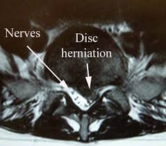 We did not find results for: Herniated Disc Huraibi Rehab Institute
