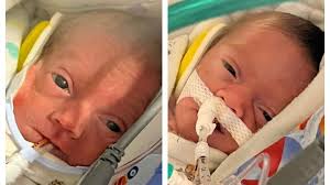 Fundraiser for Ashley Pauline by Megan Dever : The Pauline Twins Journey to  Life