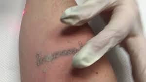 Getting my tattoo lasered off with picosure laser tattoo removal before and after first session. File Picosure Laser Tattoo Removal Ogv Wikimedia Commons