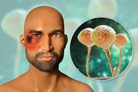 El hongo negro es una infección fúngica que ha sido detectada en la india en los últimos días, por ello, si buscas en internet india hongo negro verás cientos de noticias al respecto. Que Es El Hongo Negro Y Cuales Son Los Sintomas De Esta Enfermedad En Pacientes Con Covid 19 El Financiero