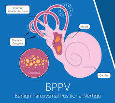 How to prevent benign paroxysmal positional vertigo (bppv). Sudden Dizziness It Could Be Benign Paroxysmal Positional Vertigo