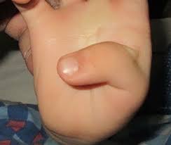 Treatment and outcomes of arthrogryposis in the upper extremity