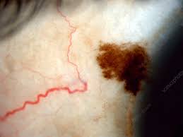 Image result for nevus sclerae