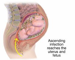 Vaginosis occurs when the balance of the bacterial flora in the vaginal ecosystem is disrupted. Signs Of An Intrauterine Infection Chorioamnionitis