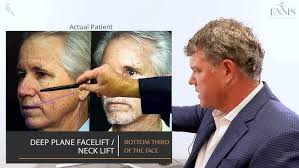 Donna Ennis, The Gentle Injector at Ennis Plastic Surgery in Boca Raton FL 