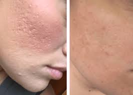 Maybe you would like to learn more about one of these? Chemical Peels For Acne Scars Cost Results Who Can T Get It