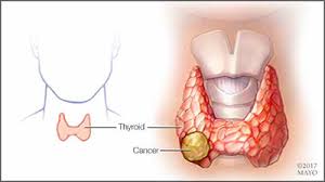 A persistent cough could be a symptom of lung cancer or head and neck cancer. What Is Thyroid Cancer Mayo Clinic Health System