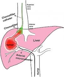 There are 11 liver diagram for sale on etsy, and they cost $33.24 on average. Diagram A New Treatment System For Liver Cancer Image Eurekalert Science News