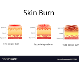 Skin Burn Three Degrees Of Burns Type Of Injury