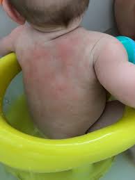 04.01.2017 · food allergy symptoms typically appear within a few minutes to two hours after consumption of the allergen. Food Allergy Symptoms Weaning Advice On Allergies When Weaning