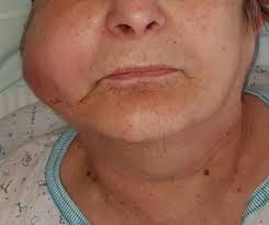 Image result for phlegmon on face)