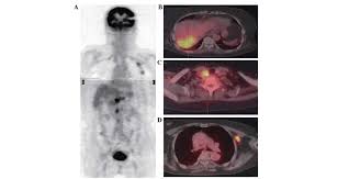 If requested before 2 p.m. Primary Intrahepatic Malignant Mesothelioma With Multiple Lymphadenopathies Due To Non Tuberculous Mycobacteria A Case Report And Review Of The Literature