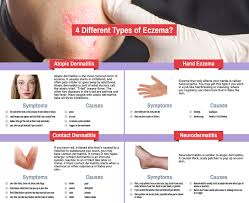 Image result for Allergic Triad