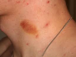Minor trauma is another common cause of petechiae. Purpura Dermnet Nz