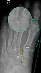 Image result for Ankle XRay
