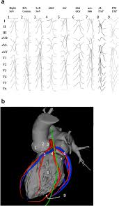We did not find results for: 2019 Hrs Ehra Aphrs Lahrs Expert Consensus Statement On Catheter Ablation Of Ventricular Arrhythmias Springerlink