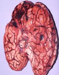 Image result for Brain Contusion