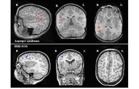 Now it is identified as one form of the autism spectrum disorder diagnosis people diagnosed with asperger's syndrome typically have high intelligence and no speech delays. Representation Of Meg Dipoles On Mri Scans In A Case Of Asperger S Download Scientific Diagram