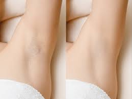 For years, there have been treatments used to remove underarm hair, especially for women. Underarm Laser Hair Removal In Toronto For Men Women Vs Medspa