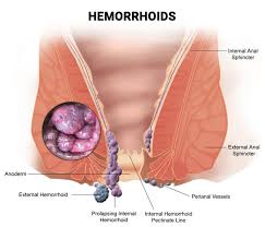 Piles and hemorrhoids evaluation