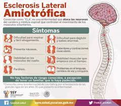Dirección de esta página la esclerosis lateral amiotrófica o ela, es una enfermedad de las neuronas en el cerebro, el el aumento de la dificultad para deglutir, la dificultad respiratoria y los episodios de apnea son síntomas que requieren atención inmediata. Esclerosis Lateral Amiotrofica On Twitter Te Mostramos Algunos De Los Sintomas Que Te Puede Ocasionar Esta Enfermedad