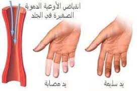 تحية يقتل كاتب ملفات ما سبب برودة القدمين عند النساء dsvdedommel com