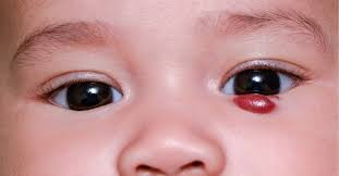 Storchenbiss Und Blutschwamm Hamangiom Beim Baby Baby At