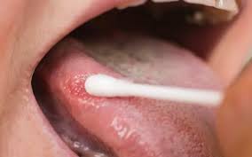 Image result for cancer of tongue