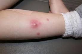 Mum's sepsis warning after 'red line' appears on son's arm. Cellulitis Practice Essentials Background Pathophysiology