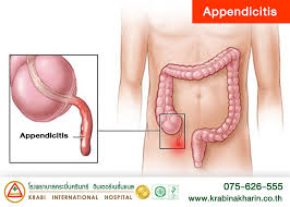 Image result for Appendicitis