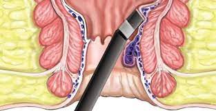 ماهي البواسير الداخلية وما أعراضها وأسبابها وكيفية علاجها laser treatment natural health tips treatment