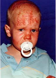 Lavender Helps Burned Boy